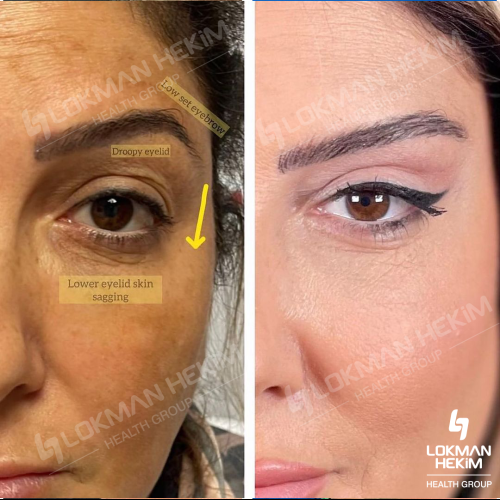 Genioplastia Foto antes/después